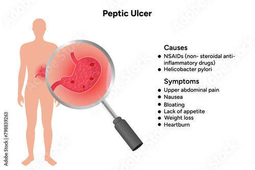 Stomach Ulcer symptoms, peptic ulcer