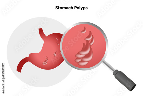 Stomach polyps. gastroenterology problem disease medical infographic 