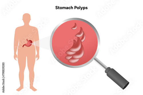Stomach polyps. gastroenterology problem disease medical infographic 