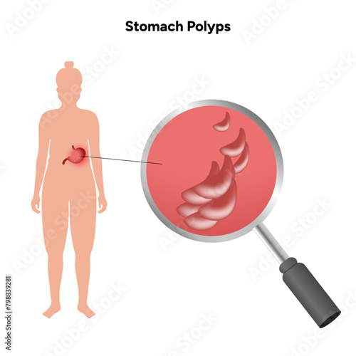 Stomach polyps