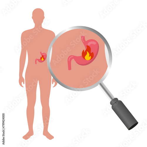 Stomach problem, acid stomach