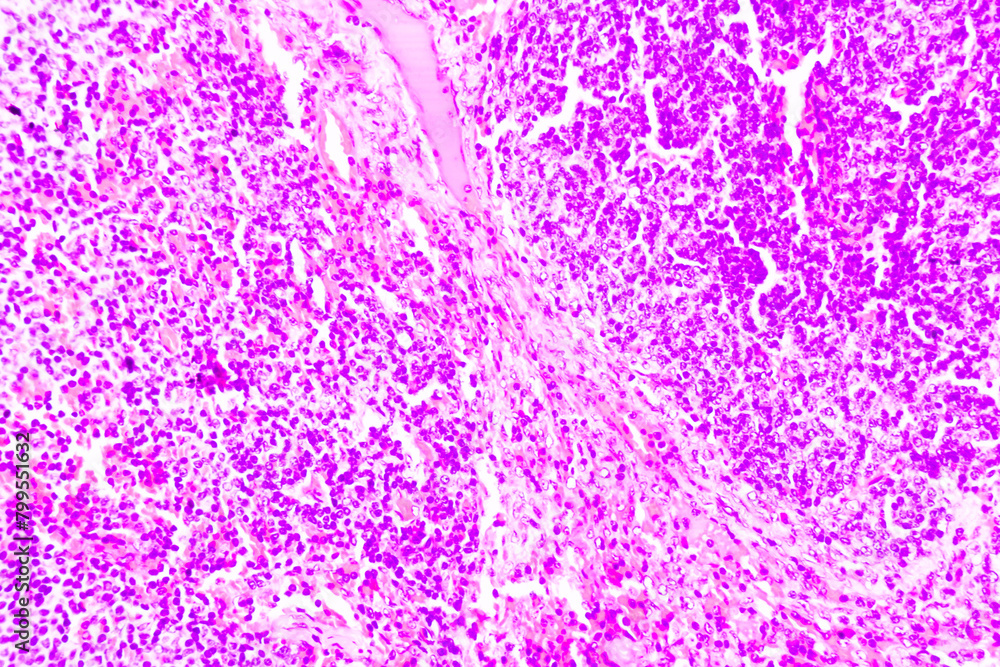 Backgrounds of human cells tissue of cervix under the microscope in pathology lab.View in microscopic of ductal cell carcinoma, adenonocarcinoma from human breast cancer, tissue section by H and E Backgrounds of human cells tissue of cervix under the microscope in pathology lab.View in microscopic of ductal cell carcinoma, adenonocarcinoma from human breast cancer, tissue section by H and E