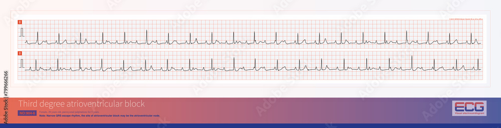 Third degree atrioventricular block in young women may be congenital, with the block located on the atrioventricular node or above bifurcation of the His bundle.
