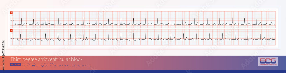 Third degree atrioventricular block in young women may be congenital, with the block located on the atrioventricular node or above bifurcation of the His bundle.
Third degree atrioventricular block in young women may be congenital, with the block located on the atrioventricular node or above bifurcation of the His bundle.