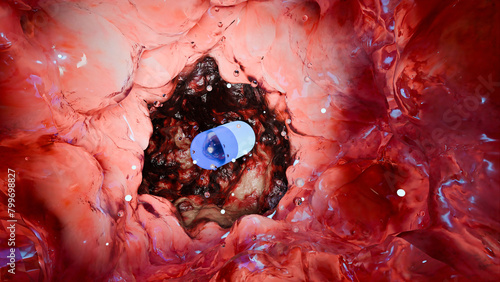 inflammatory bowel Disease traitement, Colorectal cancer, malignant tumor, Endoscope colonoscopy, gut intestine, Colon polyp removal, intestinal carcinoma, bowel neoplasia, Capsule, pill, 3d render