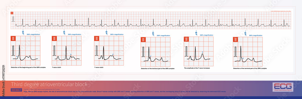 Third degree atrioventricular block in young women may be congenital, with the block located on the atrioventricular node or above bifurcation of the His bundle.
Third degree atrioventricular block in young women may be congenital, with the block located on the atrioventricular node or above bifurcation of the His bundle.