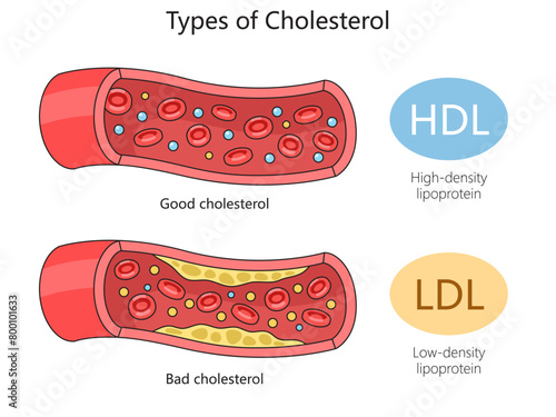 HDL good cholesterol and LDL bad cholesterol in blood vessels for health education diagram hand drawn schematic vector illustration. Medical science educational illustration