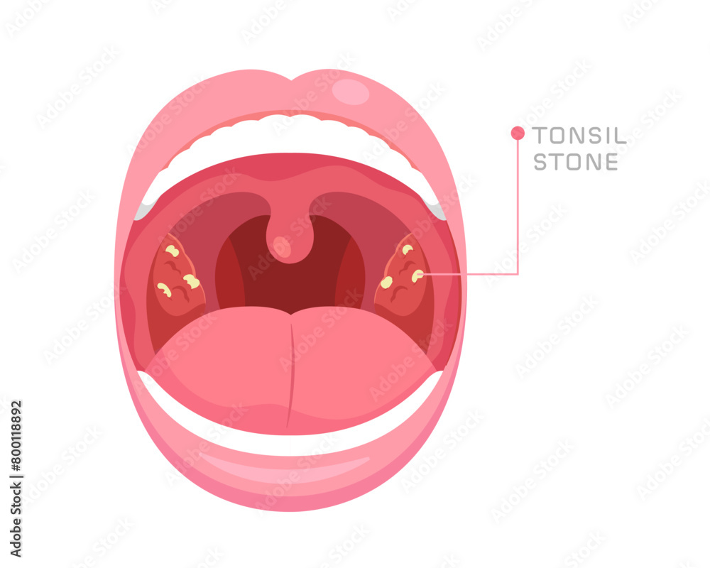 Illustration of mouth anatomy with tonsil stones in tonsil gland. Concept of bad breath, oral
