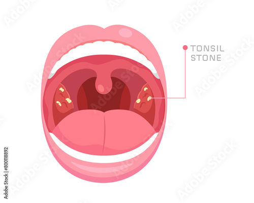 Illustration of mouth anatomy with tonsil stones in tonsil gland. Concept of bad breath, oral health, bacterial and viral infection at tonsil gland, sore throat, halitosis. Flat vector illustration. photo