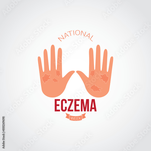 National Eczema Week vector illustration. National Eczema Week themes design concept with flat style vector illustration. Suitable for greeting card, poster and banner.