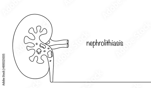 Urolithiasis