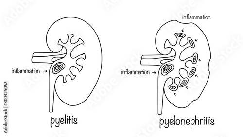 Pyelitis and pyelonephritis