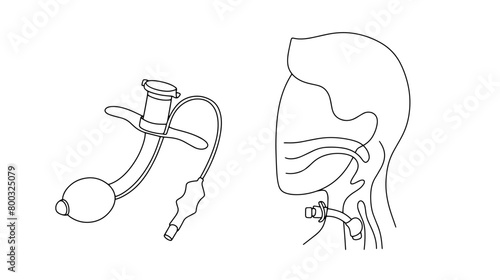 Tracheostomy