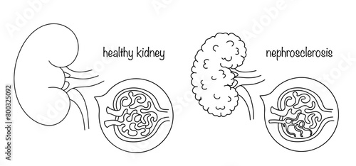 Nephrosclerosis