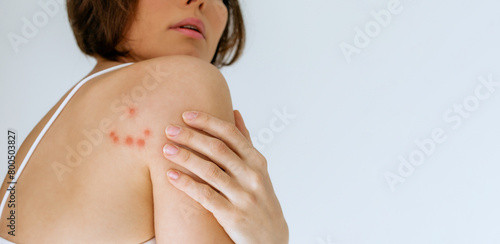 Photos A woman scratches her shoulder bitten by a bedbug on a white background, close-up