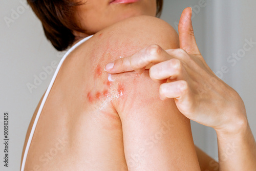 Tablou pe pânză A woman applies ointment to her shoulder that was bitten by a bedbug on a white background, close-up
