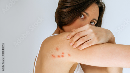 A woman scratches her shoulder bitten by a bedbug on a white background, close-up. Skin health problem. Red pimples. photo