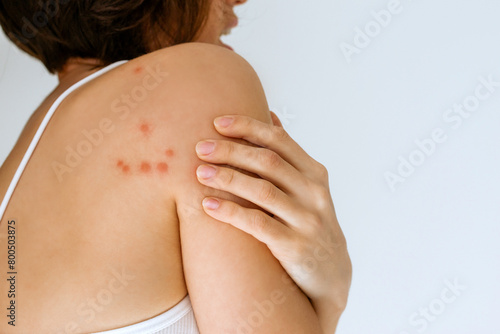 A woman scratches her shoulder bitten by a bedbug on a white background, close-up. Skin health problem. Red pimples.