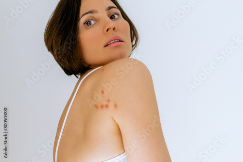 A woman with her shoulder bitten by a bedbug on a white background, close-up. Skin health problem. Red pimples