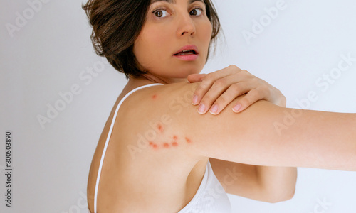A woman scratches her shoulder bitten by a bedbug on a white background, close-up. Skin health problem. Red pimples.