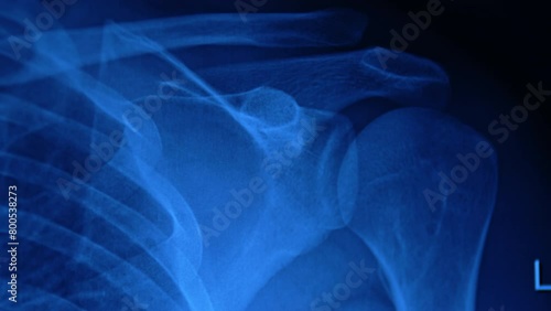 X-ray shot of a shoulder joint. Close up. Scanning before the surgery for trauma healing. photo