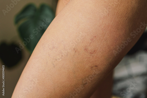 Varicose veins. Vascular diseases. Varicose veins of small vessels on the skin of a woman's thigh. Varicose veins on the woman legs, Vascular, Thrombosis.