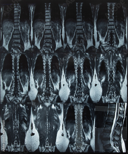 x-ray thoracic and lumbar vertebrae spine x-ray film images by mri ct scan of spine anatomy for a medical diagnosis.