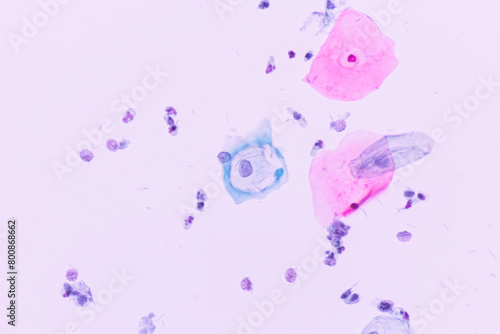 Abnormal squamous epithelial cells view in microscopy.HPV criteria for pap smear slide cytology and pathology.Koilocyte cells on white background.Human cell medical concept.