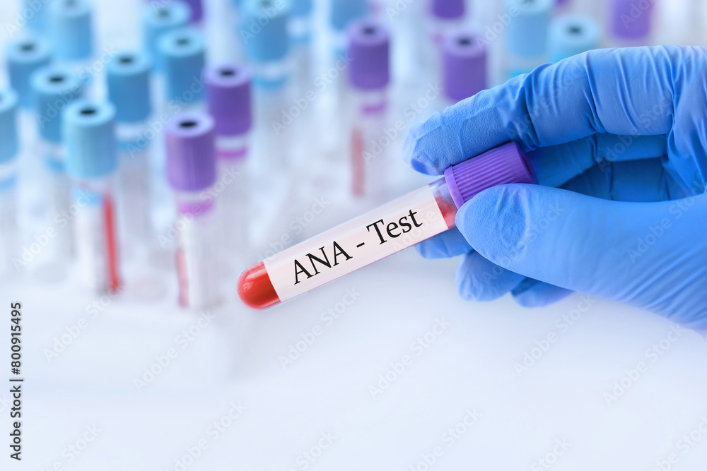 Doctor holding a test blood sample tube with ANA test on the background of medical test tubes with analyzes. Doctor holding a test blood sample tube with ANA test on the background of medical test tubes with analyzes.