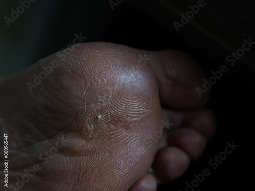 callus on a woman's foot photo