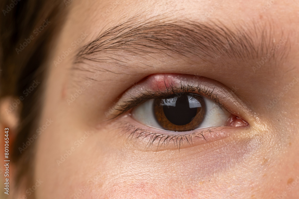 Fototapeta premium Chalazion on the eyelid of girl macro. Demodicosis mite diseas, demodex. Eye of girl with stye close-up.