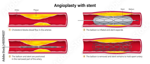 Steps of angioplasty with stent. Balloon is inflated, stent expands so that it holds open the narrowed blood vessel. Balloon is let down and removed, leaving the stent in place.