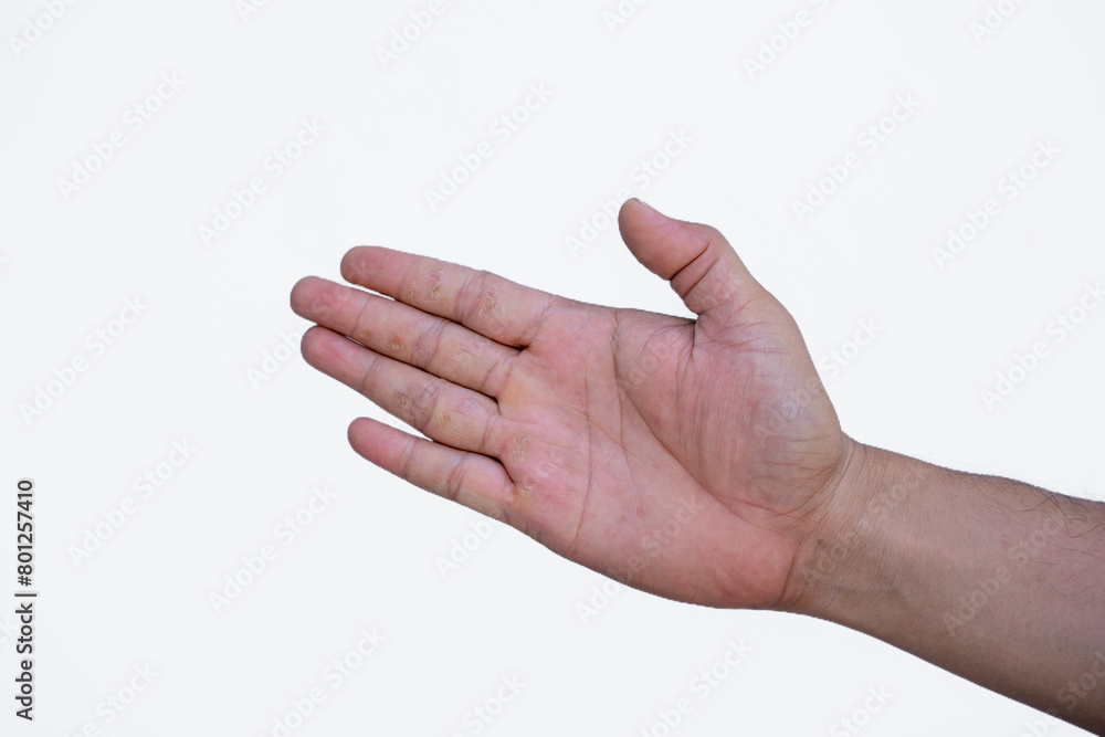 Fototapeta premium skin disease