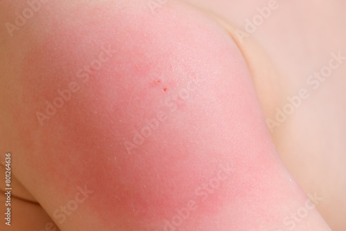 Swelling and redness on the child's shoulder after vaccination. Side effect of the vaccine in a child