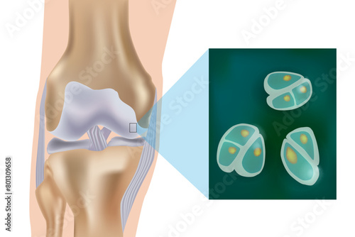 Schematic depiction of articular cartilage and chondrocytes of the joint surface. Structural and molecular changes during OA process. Chondrocytes photo