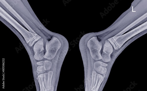 X-ray image of both ankles in lateral view.