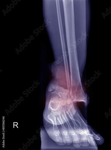 X-ray image of a patient with a broken ankle. Blue tone and normal color. The image can be separated. Black background.