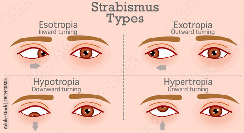 Strabismus types, crossed eyes, disease. Inward turning, outward, upward, downward. Esotropia, hypotropia, exotropia, hypertropia,. Skin color background. Vector illustration	 photo