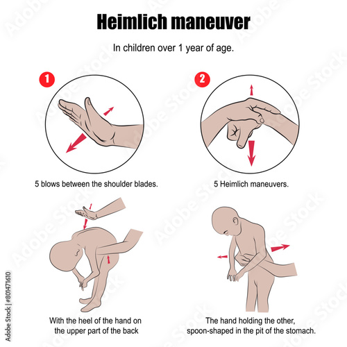 Heimlich maneuver, first aid procedure used when a person is drowning.