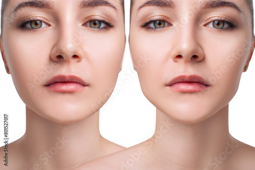 Woman before and after cheekbones shape correction.