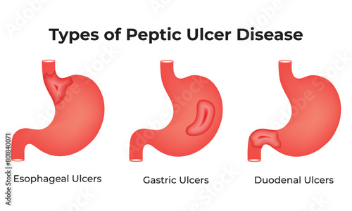Types of Peptic Ulcer Disease Science Vector Illustration.