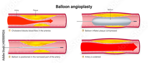 Steps of balloon angioplasty vector. Balloon in The Treatment of Coronary Artery Disease. Treatment of clogged arteries.