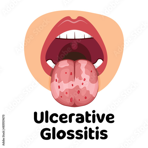 Ulcerative Glossitis vector illustration