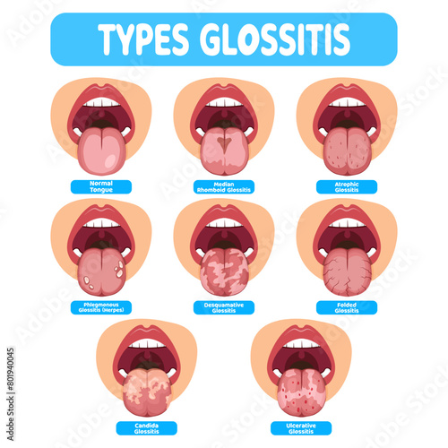 Types Glossitis vector illustration