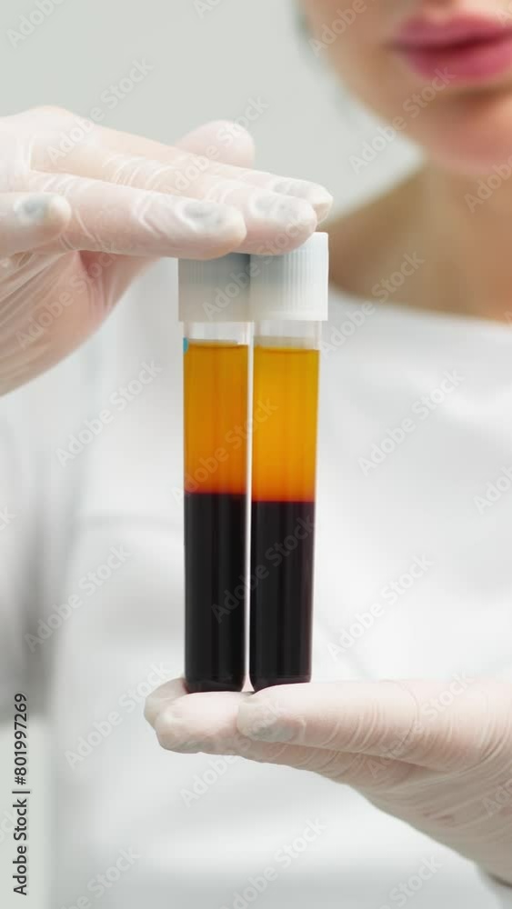 Vertical video. A cosmetologist in a white coat and gloves checks and demonstrates a blood collection tube with centrifuged blood - separated, rich in platelets and plasma. Vertical video. A cosmetologist in a white coat and gloves checks and demonstrates a blood collection tube with centrifuged blood - separated, rich in platelets and plasma.