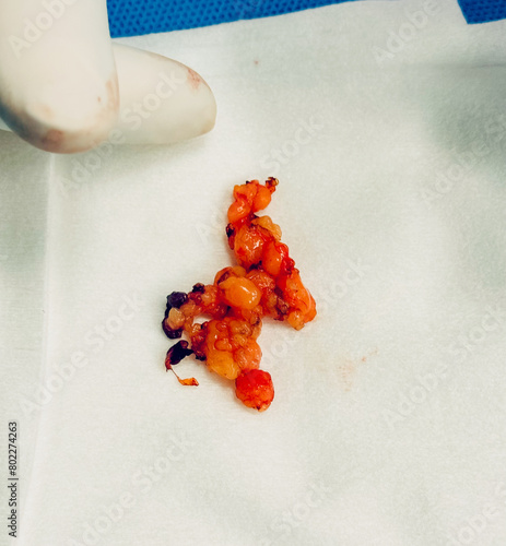 photo of adepose tissue removed from upper lid of the human eyes by blepharoplasty surgery photo