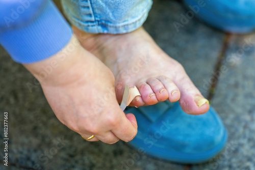 Valokuva Female hands applying a bandage to a callus on a foot with damaged toenails