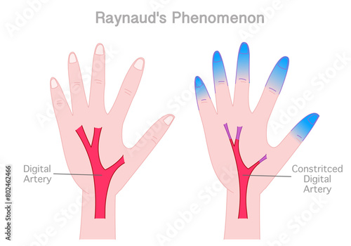 Raynaud phenomenon. Cold hands syndrome. usually Fingers and toes. Comparison ice, limb disease. Condition that causes blood vessels going to certain. Vector illustration © LuckySoul