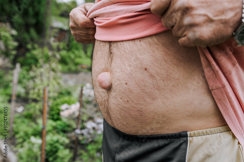 An adult elderly man shows a large umbilical hernia on his abdomen. Close-up photo, disease concept.
