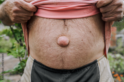 An adult elderly man shows, demonstrates a large umbilical hernia on his abdomen. Close-up photo, disease concept. photo